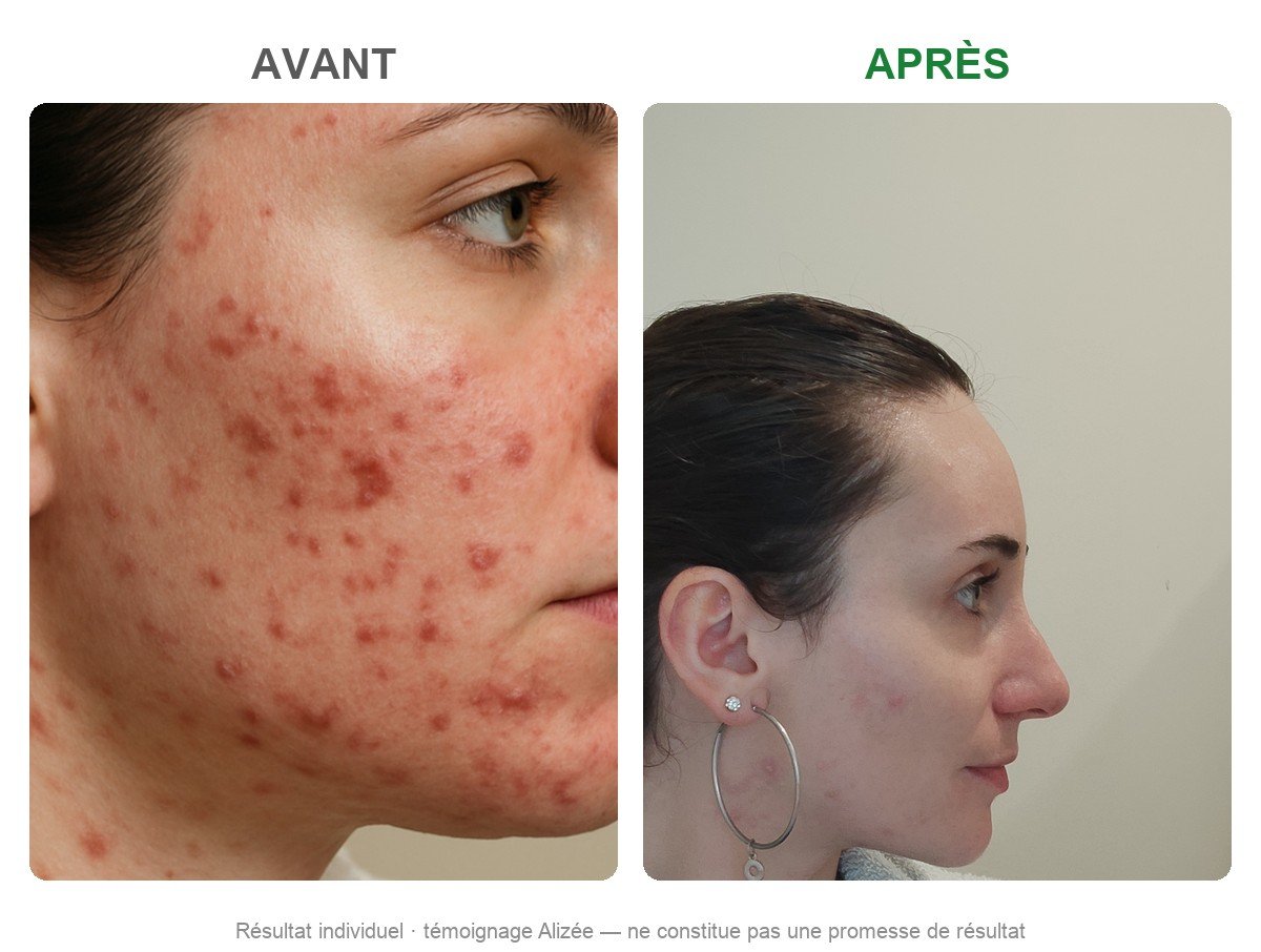Avant / après — témoignage Alizée (CLEAR)